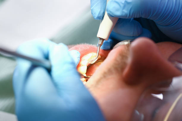 Best Emergency Wisdom Teeth Removal in Woodlawn, OH